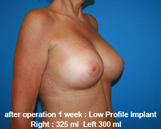 plastic-surgery-breast-augmentation